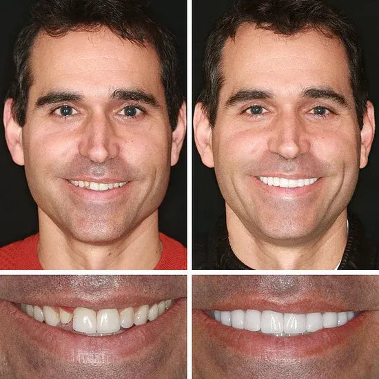 🏆 Ends Today: Save Up to 50% — A 2026 Customer Favorite for a More Comfortable, Confident Smile 🌎