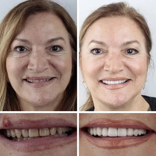 🏆 Ends Today: Save Up to 50% — A 2026 Customer Favorite for a More Comfortable, Confident Smile 🌎